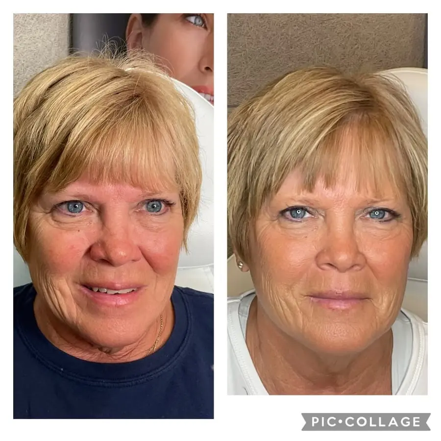 NFuze patient result, front view before and after treatment